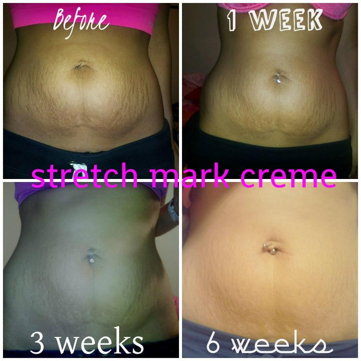Anti Stretch Mark Cream ( Original )
